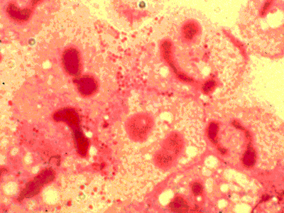  N. meningitidis (pequeninos pontos vermelhos) é a bactéria causadora da doença meningocócica 